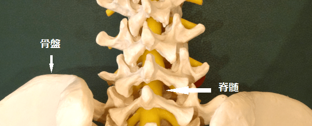 脊柱管狭窄症の写真
